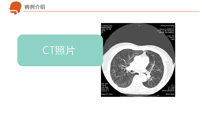 呼吸衰竭护理治疗病例分析PPT模板